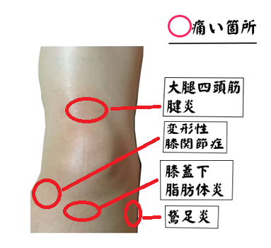 膝痛